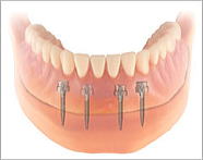 ミニインプラント義歯3